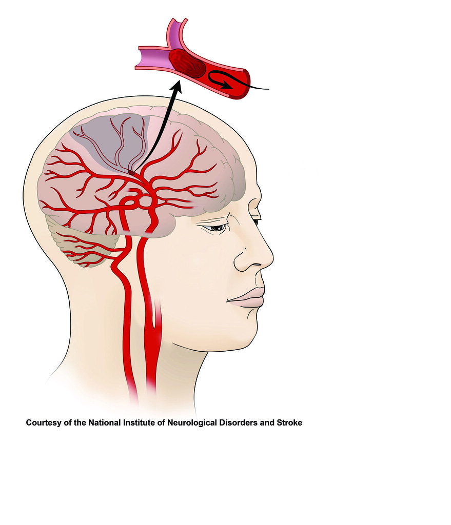 Stroke - Causes and Prevention
