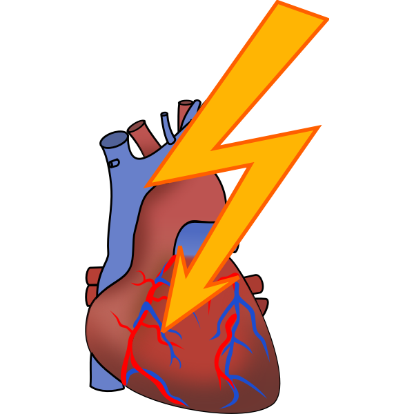 Understanding Heart Attacks: Causes and Treatment Approaches Explored